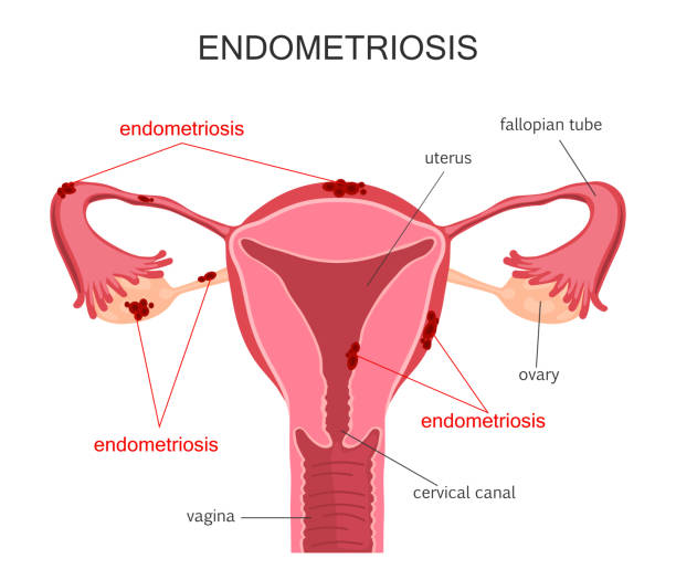 endometriosis treatment in vile parle